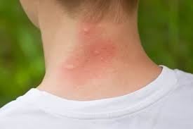 Mosquito bite on the back of a boy’s neck.