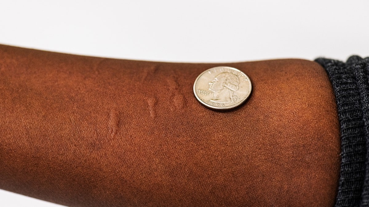 Photo showing multiple mosquito bites on a person's forearm and a U.S. quarter to show scale