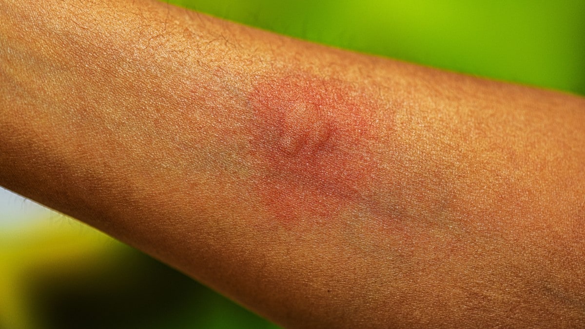 Photo showing multiple mosquito bites on a person's forearm