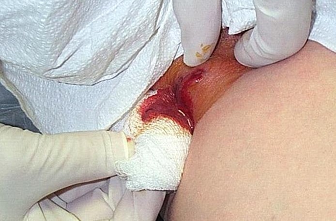 Photograph depicted a cutaneous abscess, caused by MRSA