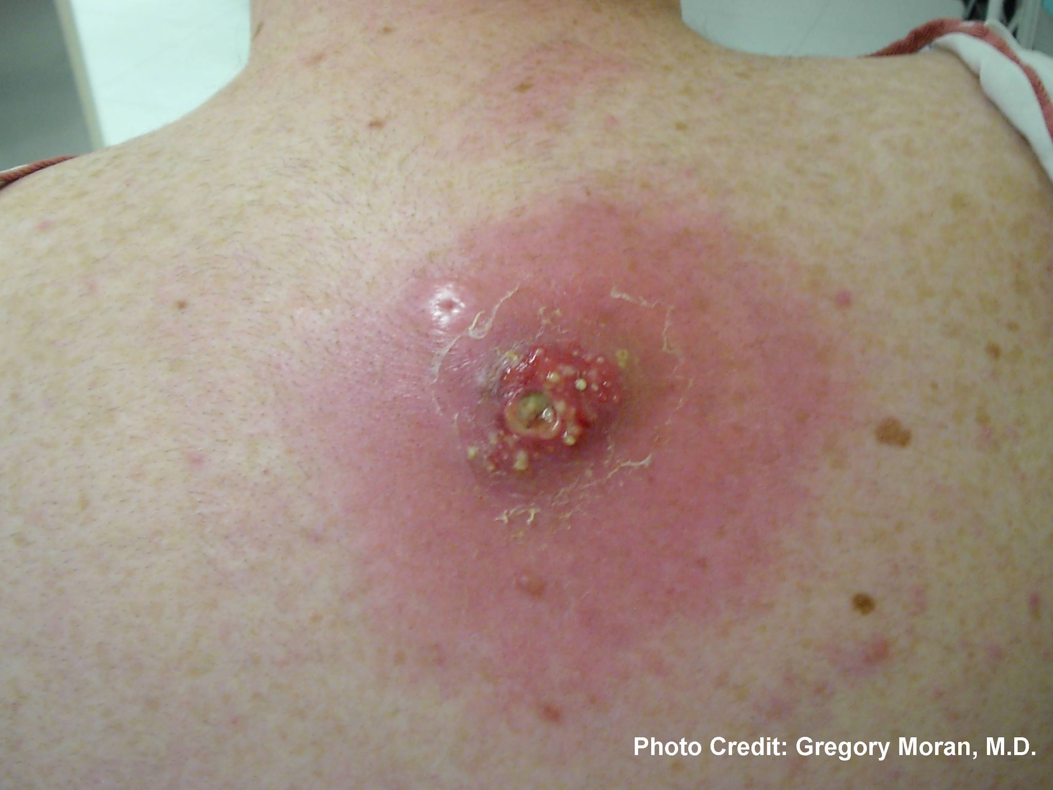 Photograph depicted a cutaneous abscess, caused by MRSA