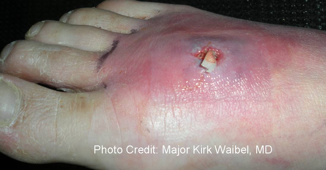 Photograph depicted a cutaneous abscess on the foot post packing (side view).