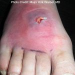 Cutaneous abscess on the foot post packing (front view)