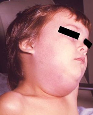 Child with mumps