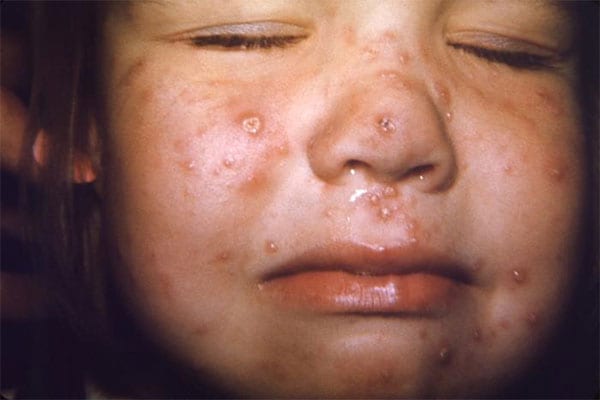 Chickenpox rash on young child's face
