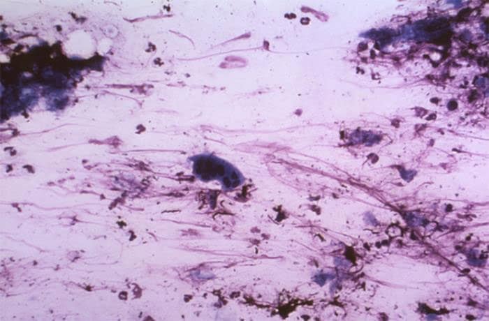 Varicella-zoster virus under microscope