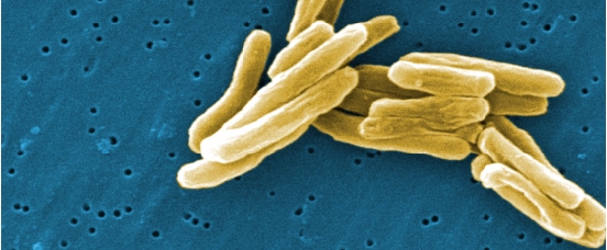 Reports a sharp increase in cases of tuberculosis in the United States, linked to HIV infection and AIDS
