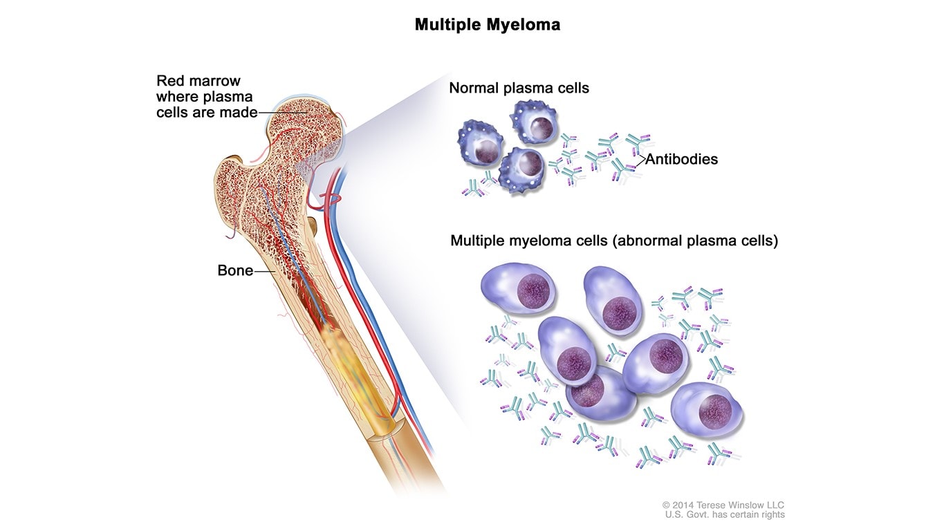 Drawing shows normal plasma and multiple myeloma cells, or abnormal plasma cells, inside the bone marrow.