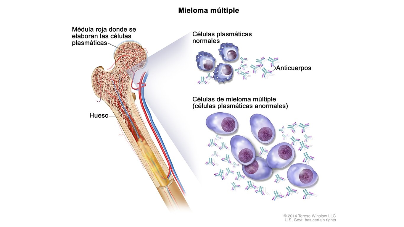 Diagrama que muestra las células plasmáticas normales y las células de mieloma múltiple, o células plasmáticas anormales, dentro de la médula ósea.
