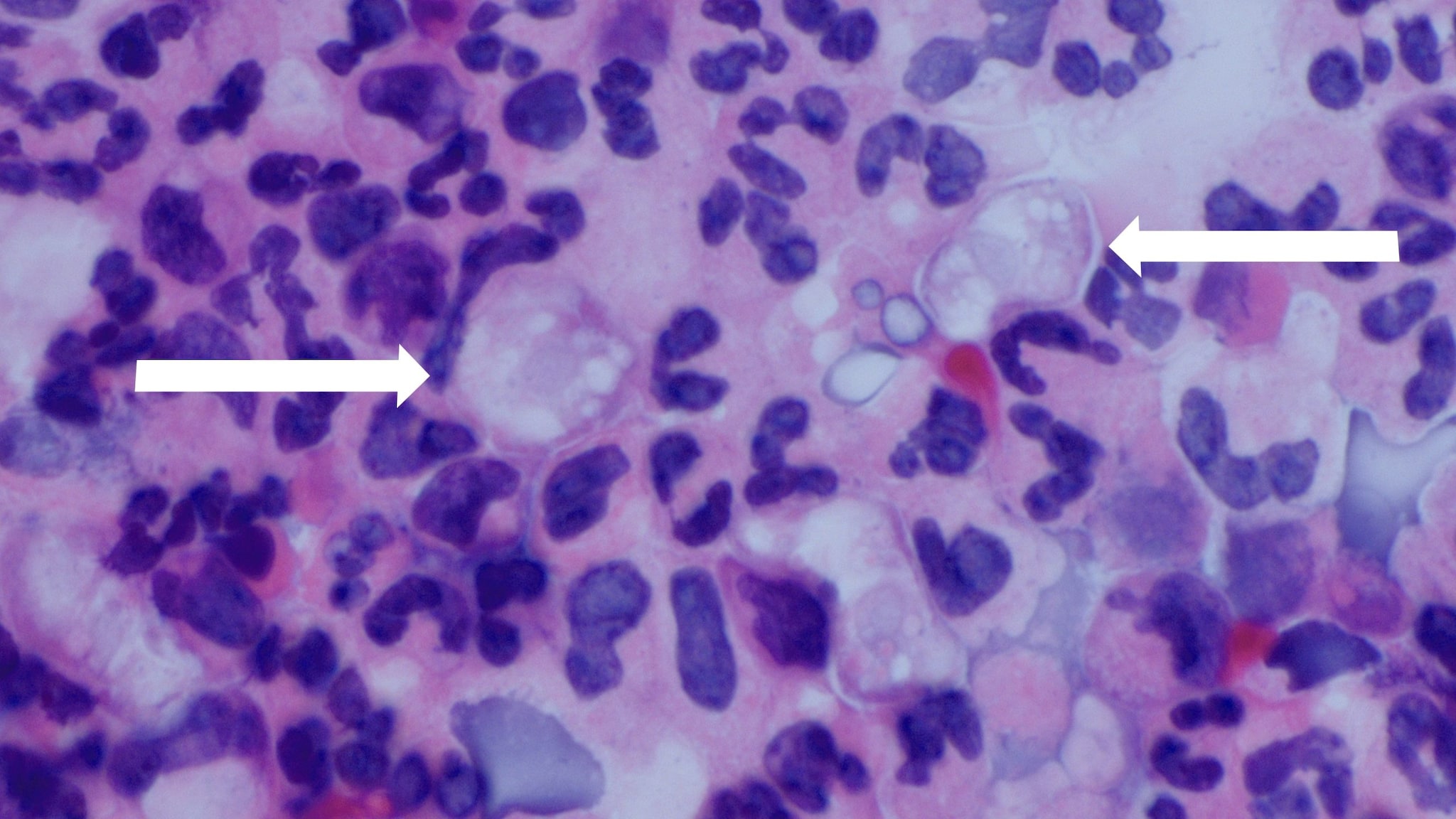High resolution of a person's cerebrospinal fluid. Two arrows point to Naegleria fowleri amebas