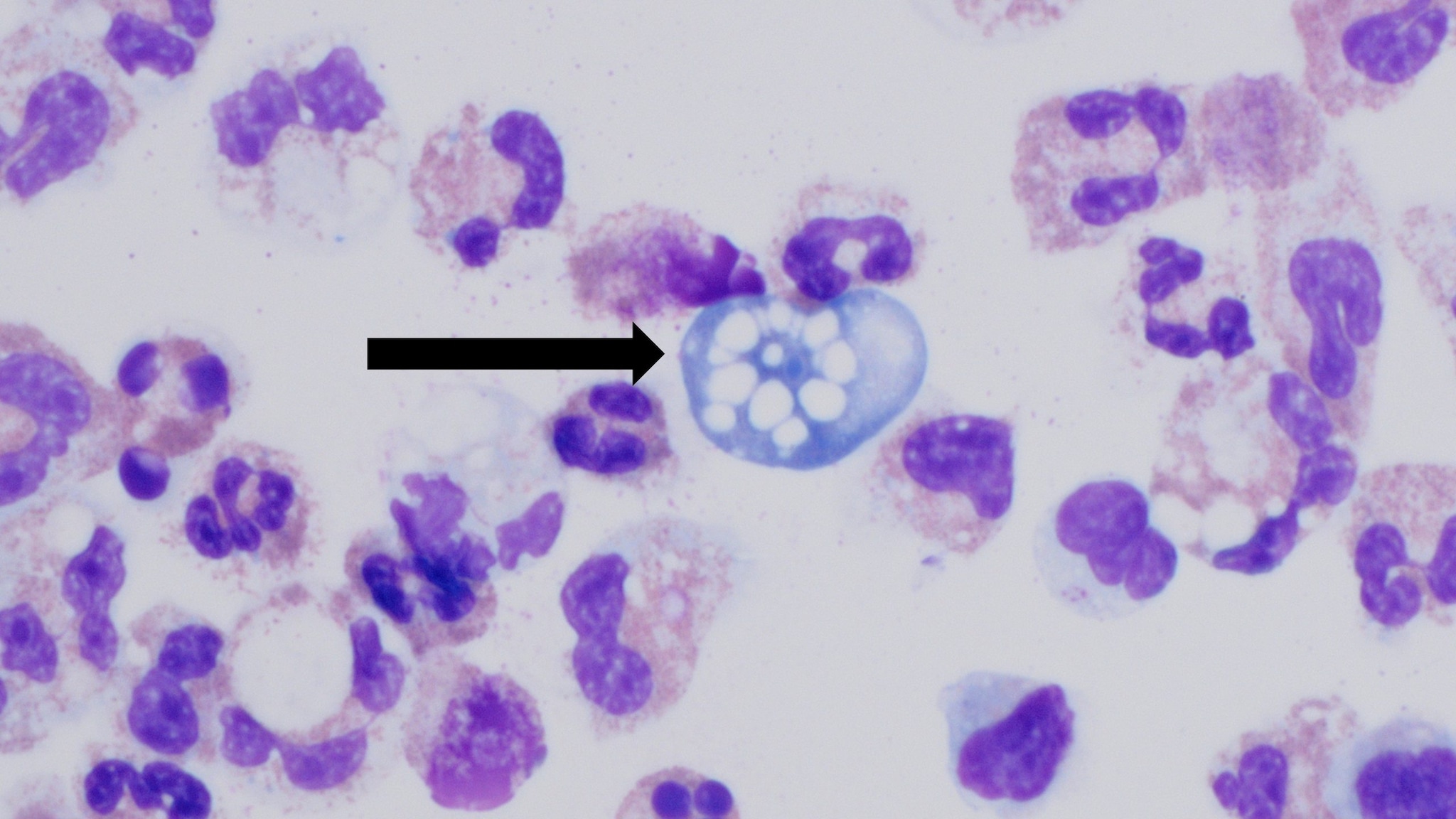 High resolution of Naegleria fowleri ameba in a person's cerebrospinal fluid