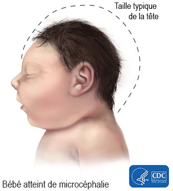 Bébé atteint de microcéphalie, Taille typique de la tête