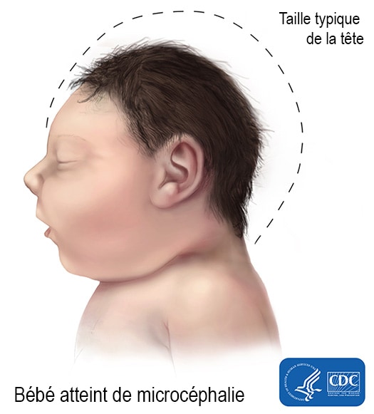Bébé atteint de microcéphalie, Taille typique de la tête