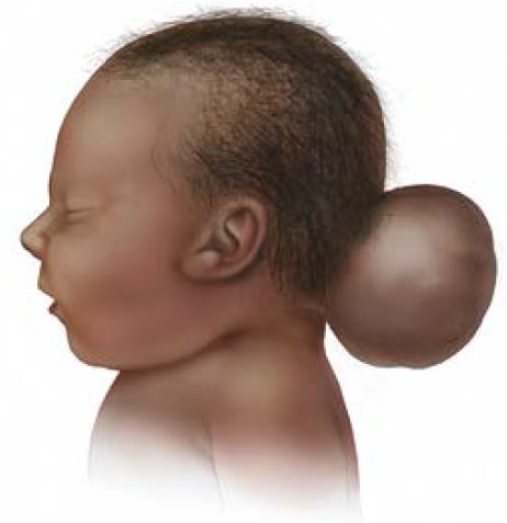 Meaning anencephaly Anencephaly: What