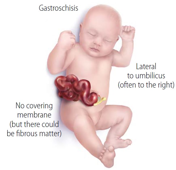Facts about Gastroschisis