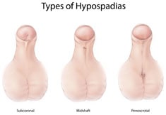 Picture of Types of Hypospadias