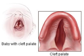 Baby with Cleft Palate