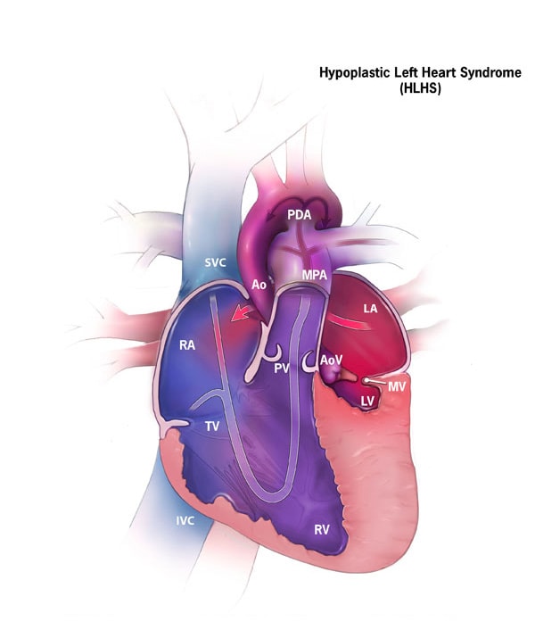 Hypoplastic Left Heart Syndrome