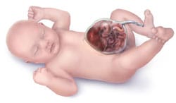Picture of Omphalocele