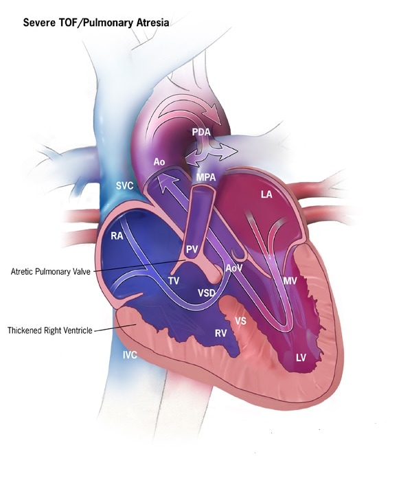 Pulmonary Atresia with Ventricular Septal Defect