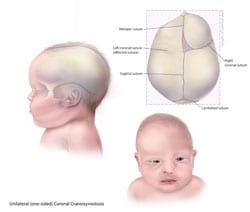 Facts about Craniosynostosis | CDC