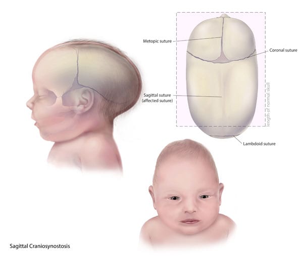 Facts about Craniosynostosis | CDC