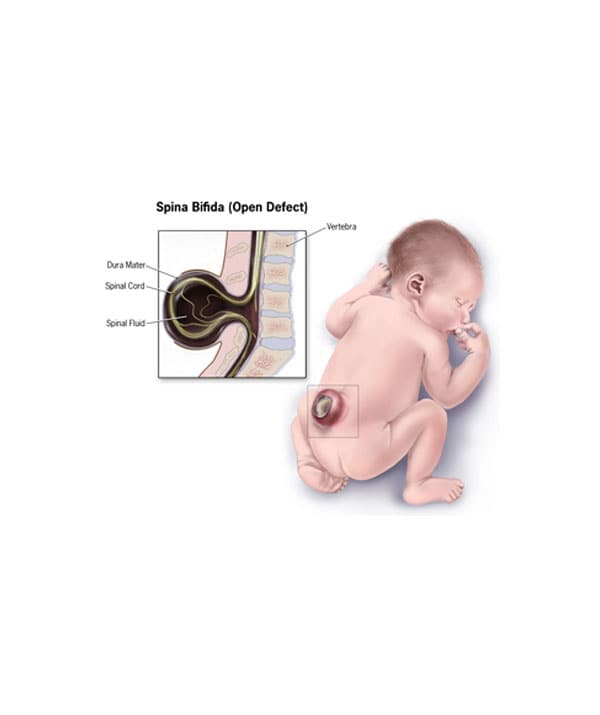 Birth Defects In Children More Common