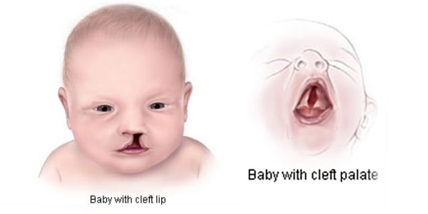 Facts about Cleft Lip and Cleft Palate | CDC