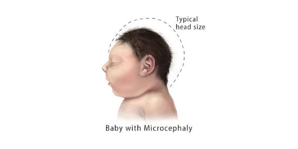 Facts about Microcephaly | CDC