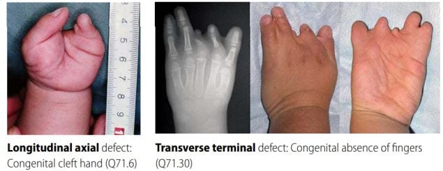 Distinguishing longitudinal axial defects from transverse terminal defects of hand/foot (side-by-side comparison)