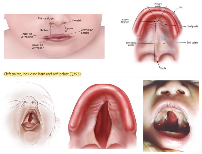 Fig. 4.22. Cleft palate, including hard and soft palate