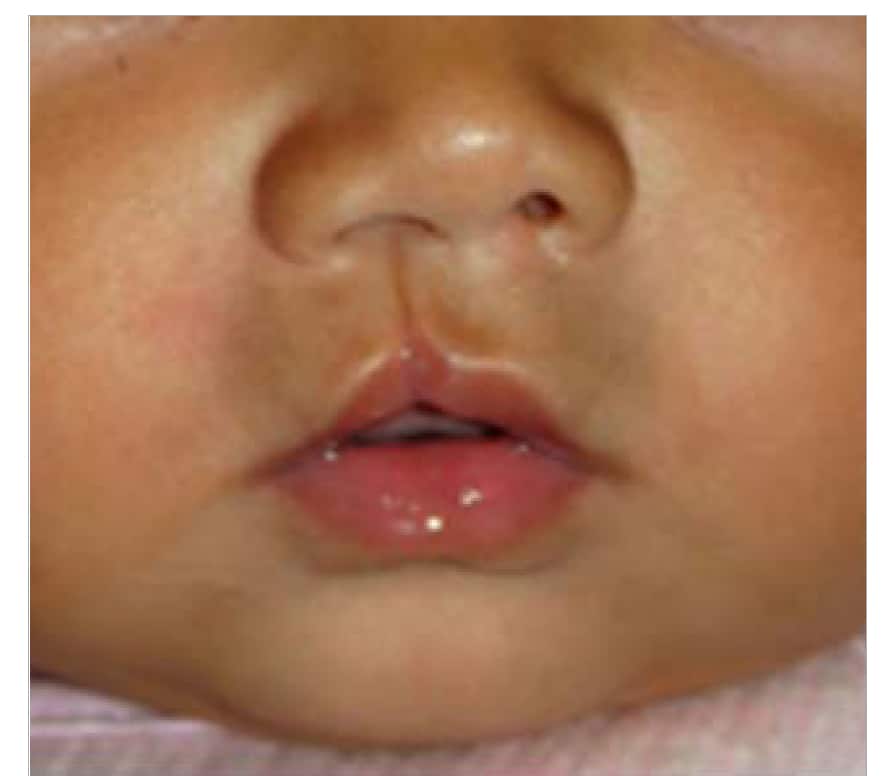 Fig. 4.25. Microform (“healed” cleft lip)
