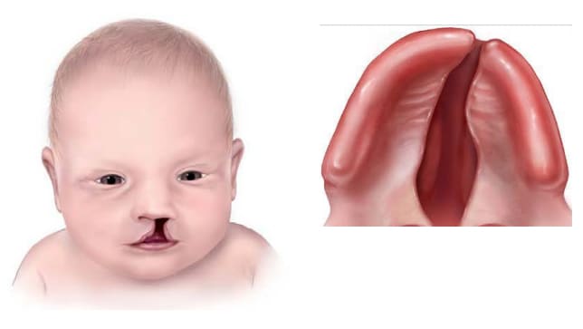 Cleft palate with unilateral cleft lip (Q37.10)
