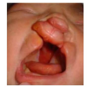 Cleft palate with bilateral cleft lip (Q37.4)