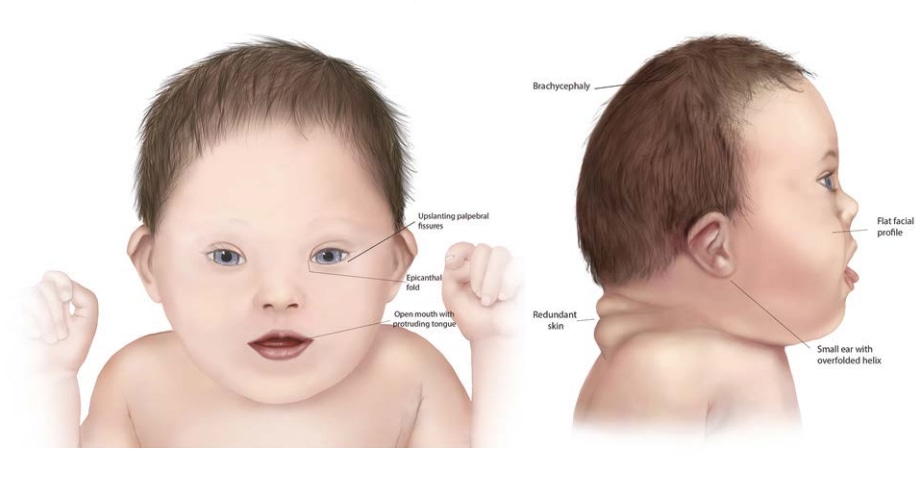 Fig. 4.44. Down syndrome