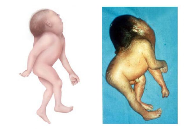 Fig. 4.5. Iniencephaly