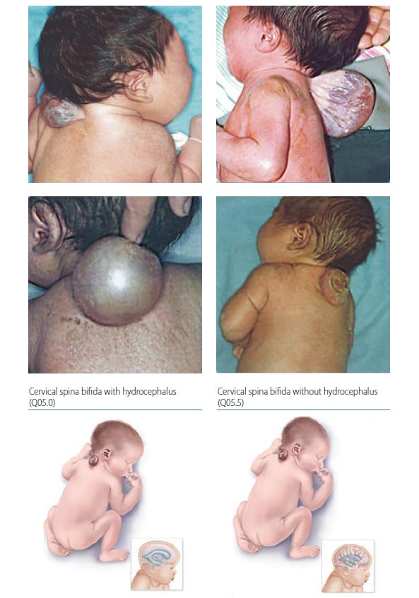 Fig. 4.8. Cervical spina bifida