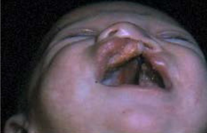 (left-sided cleft palate with cleft lip