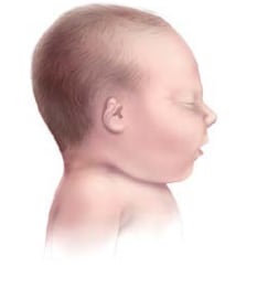 Graphic of child with Microtia-II