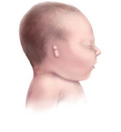 Graphic of child with Microtia-III