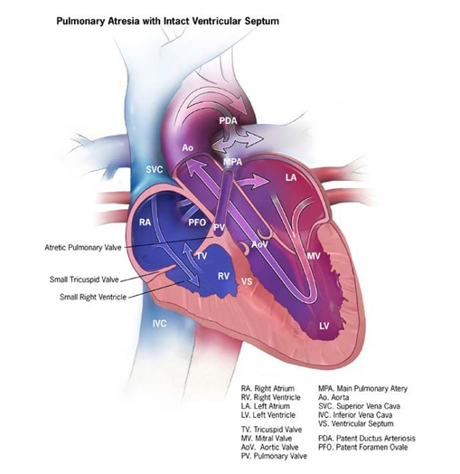 Fig. 4.18. Pulmonary valve atresia
