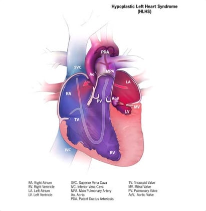 Fig. 4.20. Hypoplastic left heart syndrome