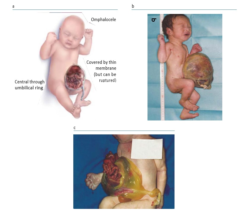 graphic of baby with Omphalocele (Exomphalos)