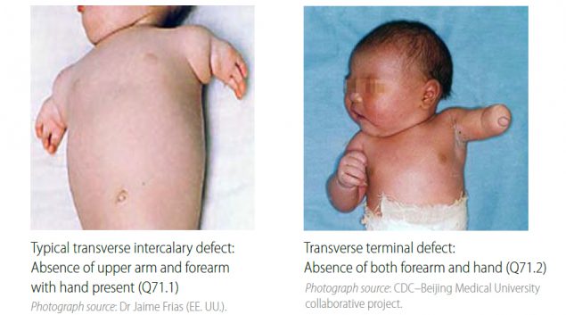 Distinguishing intercalary defects from transverse terminal defects (side-by-side comparison)