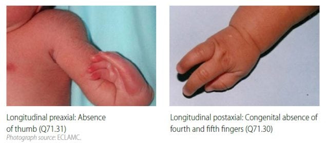 Distinguishing longitudinal preaxial defects from longitudinal postaxial defects (side-by-side comparison)