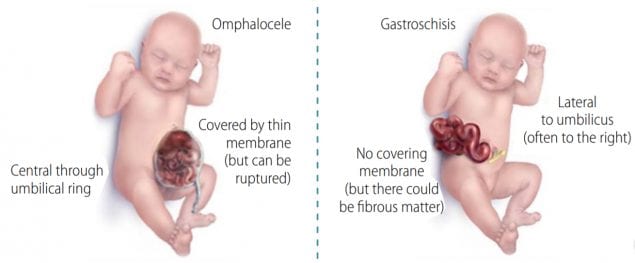 Distinguishing omphalocele from gastroschisis (side-by-side comparison)