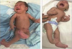 Left: Newborn infant with bilateral contractures of the hips and knees, bilateral talipes calcaneovalgus, and anterior dislocation of the knees. Right: Newborn infant with bilateral contractures of the shoulders, elbows, wrists, hips, knees, and right talipes equinovarus. Hips are bilaterally dislocated in both infants.