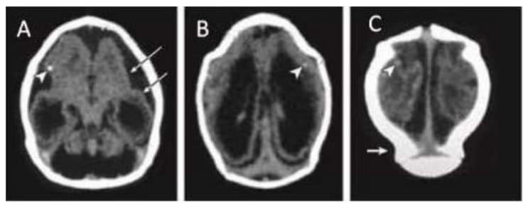 Computed tomographic (CT) scan in one infant with prenatal ZIKV exposure shows scattered punctate calcifications (A, B and C; white arrowheads)