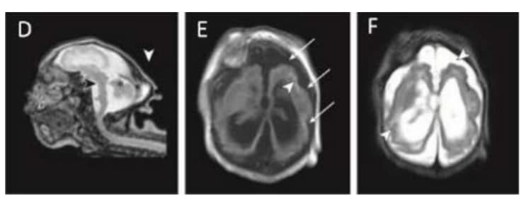 Magnetic resonance imaging (MRI) in infant with prenatal Zika exposure shows scattered punctate calcifications (E; white arrowheads), very low forehead and small cranial vault (D), striking volume loss shown by enlarged extra- axial space and ventriculomegaly (D, E and F)