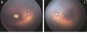 Fundus images of right and left eye: Optic nerve hypoplasia with the double-ring sign, gross pigmentary mottling, and chorioretinal scar in the macular region.